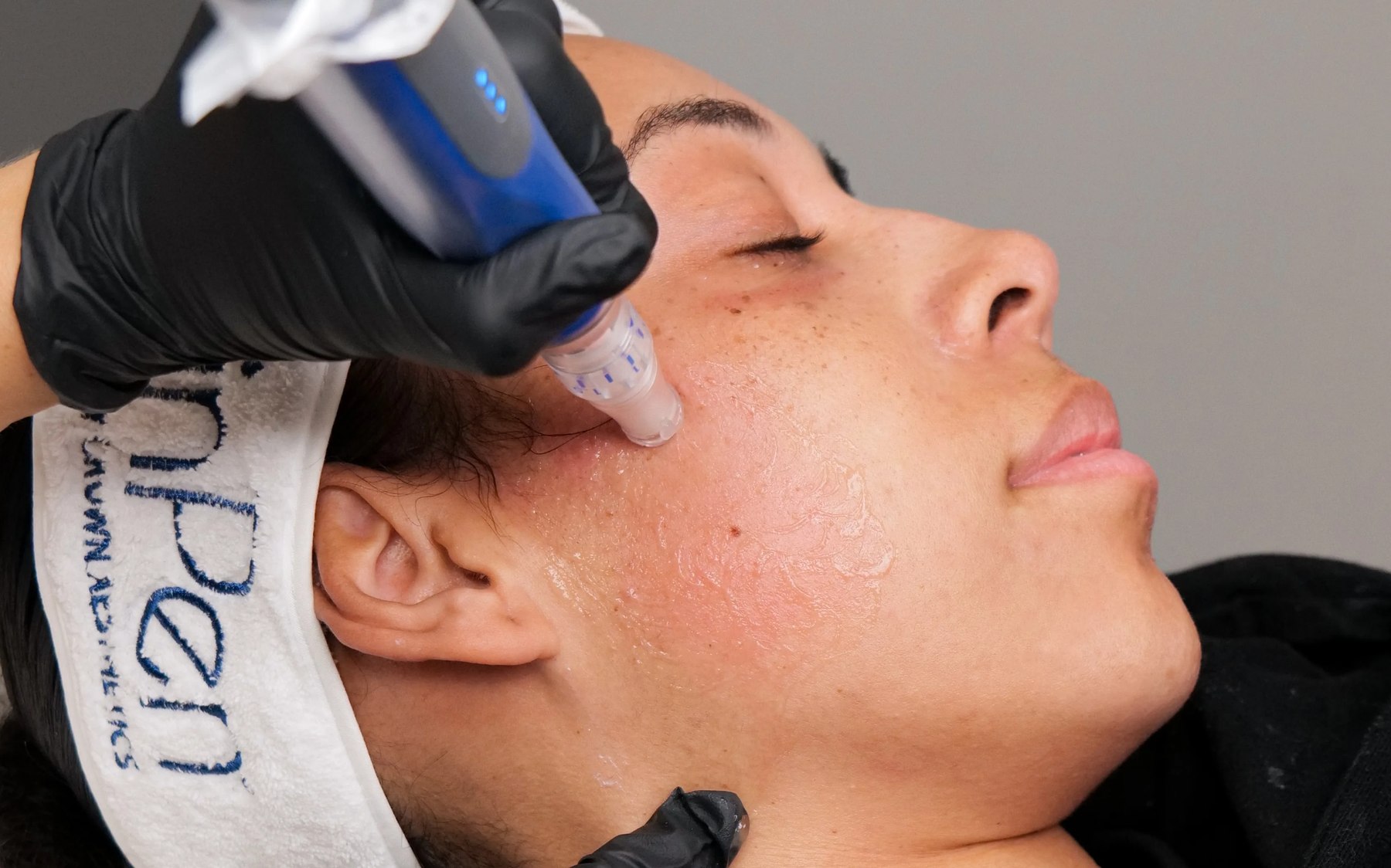 Microneedling treatment